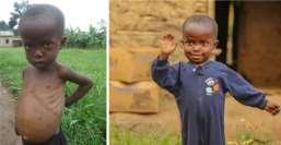He Was Just Bones Emmanuel Before FMSC Meal Packs - Emmanuel After One Year of FMSC In a remote Ugandan village, their mother died in childbirth. Their alcoholic father was often gone for weeks.