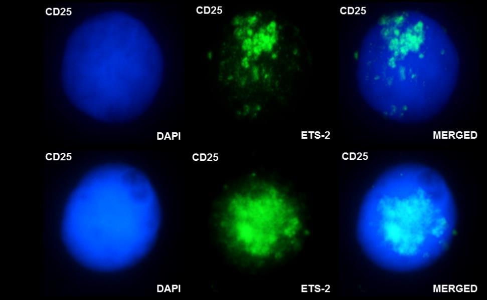 ΕΙΚΟΝΑ 38: Εντοπισμός της πρωτεΐνης Ets-2 σε απομονωμένα CD4+CD25+ Τ ρυθμιστικά λεμφοκύτταρα ασθενών και υγιών δοτών με τη χρήση ανοσοφθορισμού.