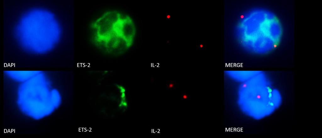 Eικόνα 39: Συνεντοπισμός της πρωτεΐνης Ets-2 και της ARRE2 αλληλουχίας του γονιδίου της IL-2 σε απομονωμένα ανθρώπινα παρθενικά και μνημονικά Τ λεμφοκύτταρα με την χρήση Immuno-DNA FISH.