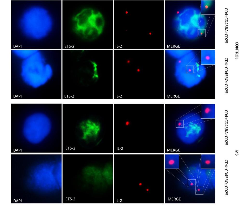 Eικόνα 41: Συνεντοπισμός της πρωτεΐνης Ets-2 και της ARRE2 αλληλουχίας του γονιδίου της IL-2 σε απομονωμένα παρθενικά και μνημονικά Τ λεμφοκύτταρα, ασθενών με σκλήρυνση κατά πλάκας και υγιών δοτών,