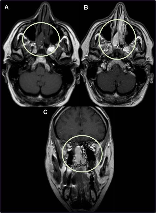 επέκταση στις οπίσθιες ηθμοειδείς κυψέλες. Εικόνα 2. MRI Α.