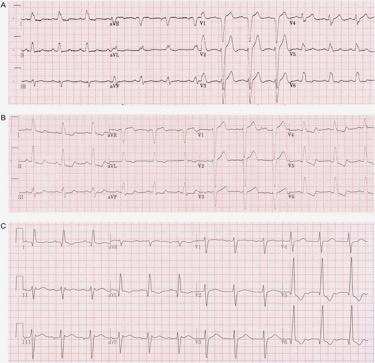 mid-qrs notching or slurring is a