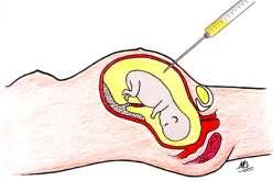 Cordonocenteza prin PUBS (percutaneous umbilical blood sampling) constă în puncţionarea transabdominală echoghidată a cordonului ombilical încă din săptămâna 17 de gestaîie.