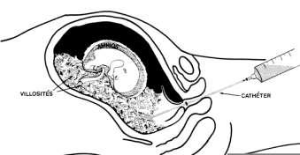 caracterizate prin sinteza de proteine anormale specifice: hemoglobinopatii (tip thalasemie), hemofilie; - suspiciune de infecţie fetală (în caz de infecţie maternă virală rubeolă, virus citomegalic