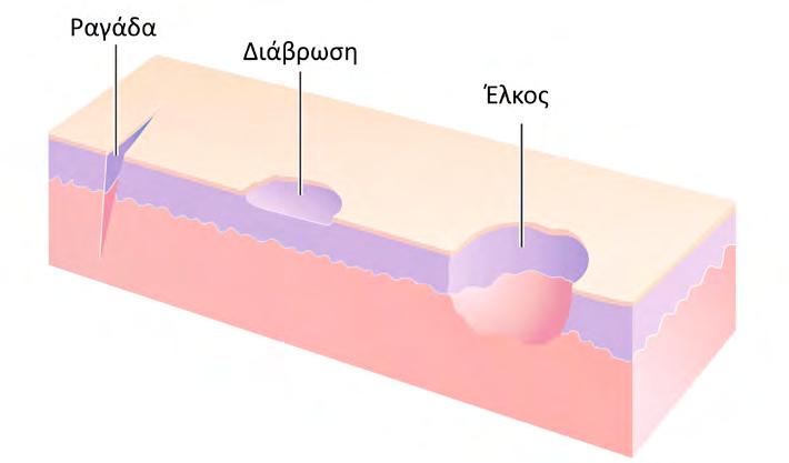 ΠΙΝΑΚΑΣ 2.4 ΔΕΥΤΕΡΟΓΕΝΕΙΣ ΣΤΟΙΧΕΙΩΔΕΙΣ ΒΛΑΒΕΣ ΤΟΥ ΔΕΡΜΑΤΟΣ (βλ. Εικόνα 2.2) ΒΛΑΒΗ ΠΕΡΙΓΡΑΦΗ Λέπια Κεράτινα πετάλια της επιδερμίδας, με ποικίλο μέγεθος, που περιέχουν κερατίνη.