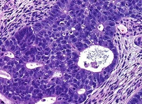 Ορισμός WHO : όγκος ο οποίος αποτελείται από αδιαφοροποίητα κύτταρα επιθηλιακής μορφολογίας με άφθονο κυτταρόπλασμα η υφή του οποίου ποικίλει από διαυγής έως κοκκιώδης ενώ υπάρχει ποικιλία προτύπων