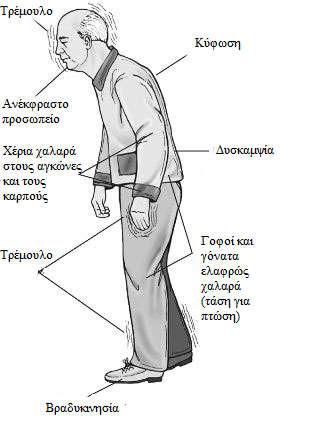 ~ 37 ~ Εικόνα 12: Συμπτώματα της νόσου του Πάρκινσον. (http://www.biomedis-technology.gr/2016/07/parkinson-sumptwmata.