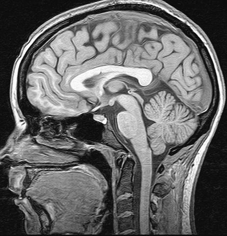 Šta se sve vidi na MRI slici? Voda? DA (H 2 O) Mast? DA (CH 2 ) Proteini? NE (malo ih je), ali utiču u na signal okolne vode Meka tkiva? DA.. Pojavnost na MRI zavisi od sastava Kosti?