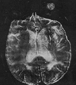EPI (Echo planar imaging) Pacijent sa