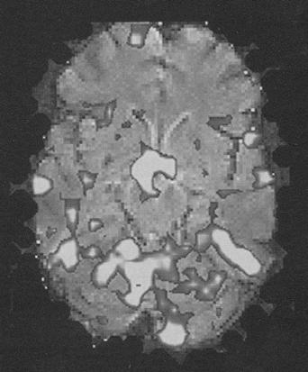fmri funkcionalni MRI Aktivnost određene regije mozga = povećana potrošnja kiseonika Oksihemoglobin (dijamagnetik) Deoksihemoglobin (paramagnetik = T2*kontrast) EPI: Lokalne nehomogenosti polja T2*