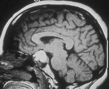 MRI direktni multiplanarni prikaz 1) G x G y G z su