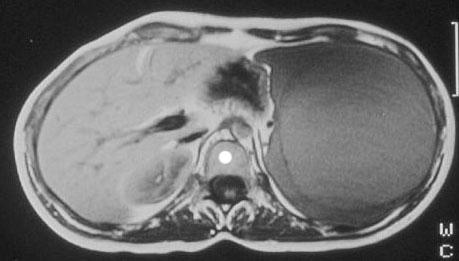MRI - cista MRI