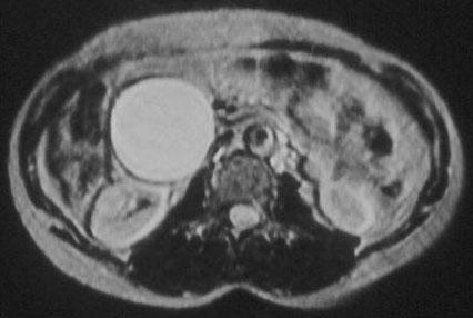 >tumor>tečnost T2W tečnost nost>tumor>mast