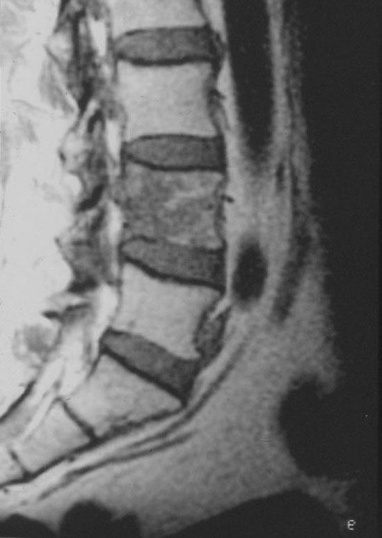 Metastaza