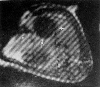 implantiranim tumorom- TR,