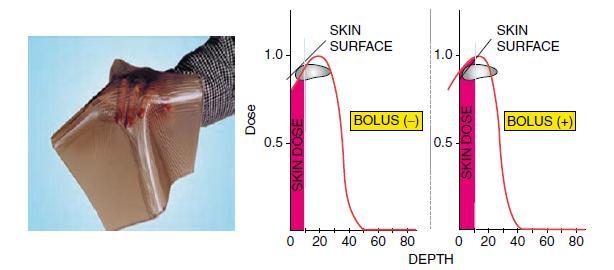 Компензаторни филтри во радиотерапијата Дистрибуцијата на дозата на површината на кожата не е хомогена доклку површината на телото која се