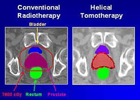 Со томотерапијата високата доза од 70 греја е ограничена само на простатата со заштота на ректуот и мочното ќесе