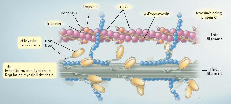 Cardiomiopatia