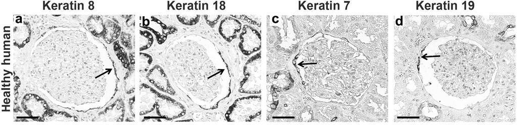 Έκφραση των κερατινών στο νεφρικό ιστό v Σπειραματική έκφραση v Οι Κ 7-8-18 και 19 (διμερή Κ8/18 και Κ7/19) εκφράζονται στα τοιχωματικά κύτταρα της κάψας του Bowman.