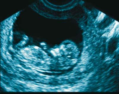 Ultrazvuk u porodništvu Izvana ili iznutra Europska udruga za perinatalnu medicinu (EAPM) preporuča najmanje tri UZV pregleda u trudnoći: prvi pregled krajem prvog tromjesečja (od 10. do 14.