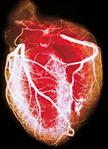 Koronarografija Koronarografija je invazivna dijagnostička procedura koja je zlatni standard za dijagnozu bolesti krvnih žila srca (koronarne bolesti).