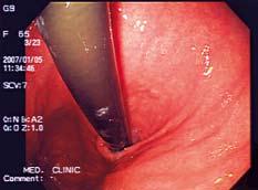 Gastroskopija JEDNIM PREGLEDOM SVE JE JASNO Endoskopija označava izraz direktnog promatranja probavne cijevi pristupom iznutra korištenjem tankog, savitljivog optičkog instrumenta zvanog endoskop.