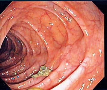 Kolonoskopija Kolonoskopija je pregled unutarnje stijenke (sluznice) organa donjeg dijela probavnog sustava, odnosno debelog crijeva.