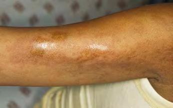 שאל את המומחה תמונה 2: נגעים של סקלרודרמה בעור הקרקפת אצל החולה. מהו הטיפול התרופתי ההתחלתי הרצוי לחולי פרקינסון? אגוניסטים דופאמינרגיים פרופ' רותי ג'לדטי המיאטרופיה צרבלרית.