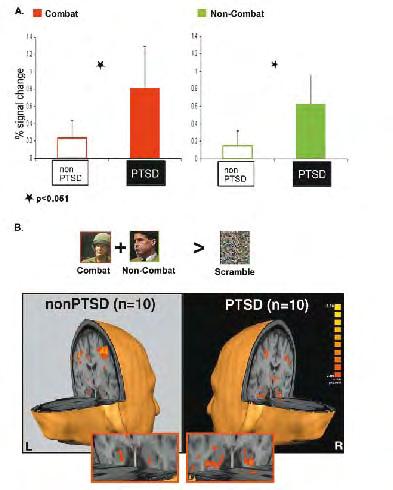 איור - 2 פעילות יתר לא סלקטיבית לתוכן של האמיגדלה אצל חולי PTSD איור 2. פעילות באמיגדלה. )A( שינוי ממוצע באחוז הפעילות בתגובה לתוכן קרבי )אדום( וניטרלי )ירוק(.