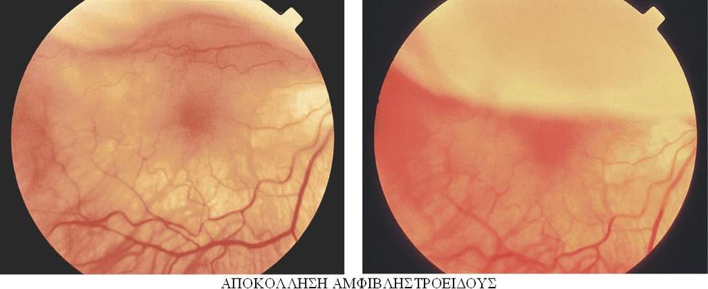 Αποκόλληση αμφιβληστροειδούς Πως προκαλείται; Η ρηγματογενής αποκόλληση του αμβφιβληστροειδούς (λατινικά: amotio retinae, αγγλικά: retinal detachment, γερμανικά: Netzhautablösung) είναι μία σοβαρή
