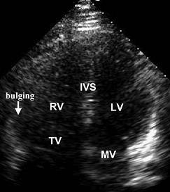 Contrast Echo enhances the ability to detect minor