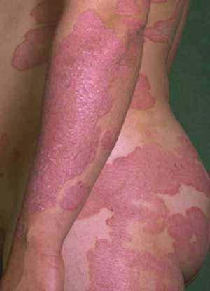 Psoriaza ali luskavica Kaj je luskavica?