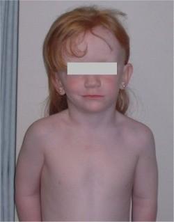 2 aastane tüdruk (pilt on illustratiivne) I/I sünnitus Sünnikaal - 3050 g, pikkus 49 cm A 8/8