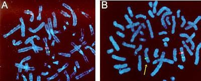FISH analüüsil leiti mikrodeletsioon 7. kromosoom http://www.