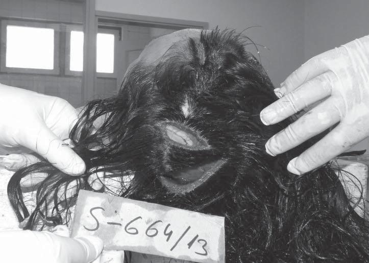 Danijela Ristic, Goran Ilic, Jelica Lazic 325 Picture 5. Head injuries. Picture 6. Display of head injuries during the autopsy.