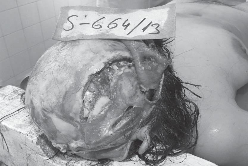 and both upper arms.from forensic aspect, brain concussion manifested through high level of disruption of brain function could be the consequence of the direct effect of sharp mechanical tool.