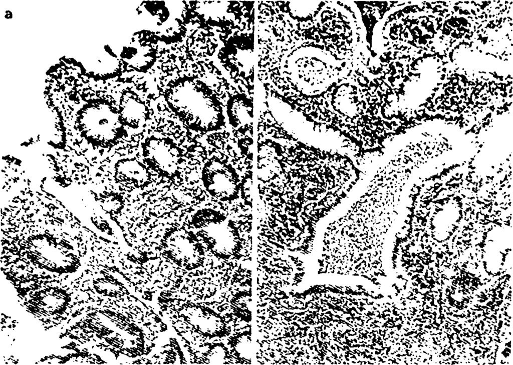 Εικόνα 14: Ελκωτική κολίτιδα, παρατηρείται ελάττωση καλυκοειδών κυττάρων και ενδοαυλικά αποστημάτια.