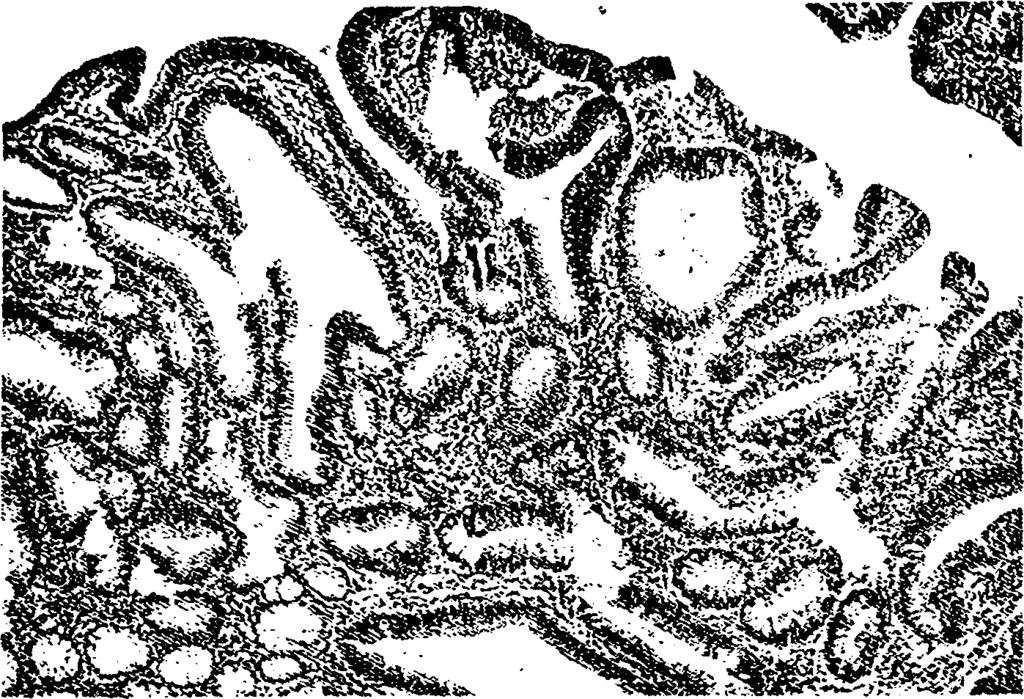 73 Εικόνα 15: Σωληνώδης αδενωματώδης πολύποδας παχέος εντέρου Γίνεται λόγος για πολυποδίαση'2 του εντέρου όταν ο αριθμός των πολλαπλών πολυπόδων υπερβαίνει τους 100.