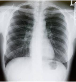 αποτέλεσμα οπίσθιο τμήμα 10 πλευρών πάνω από διάφραγμα (σωστή αναπνευστική φάση) ωμοπλάτες εκτός πνευμονικού παρεγχύματος (σωστή τοποθέτηση χεριών ) πλευρές διάφραγμα