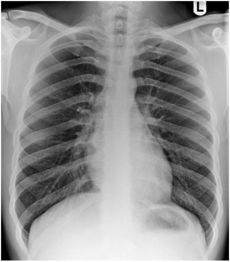 αποτέλεσμα 7 1 5 10 οπίσθιο τμήμα 10 πλευρών πάνω από διάφραγμα (σωστή αναπνευστική φάση) οπίσθιο τμήμα πλευρών αναδεικνύεται διαμέσου του πνευμονικού παρεγχύματος (σωστά στοιχεία) ωμοπλάτες εκτός