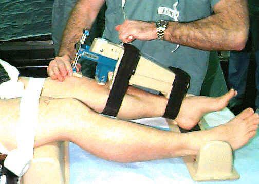 Ρήξη προσθίου χιαστού - Αρθρόμετρο Αντικειμενική μέτρηση της