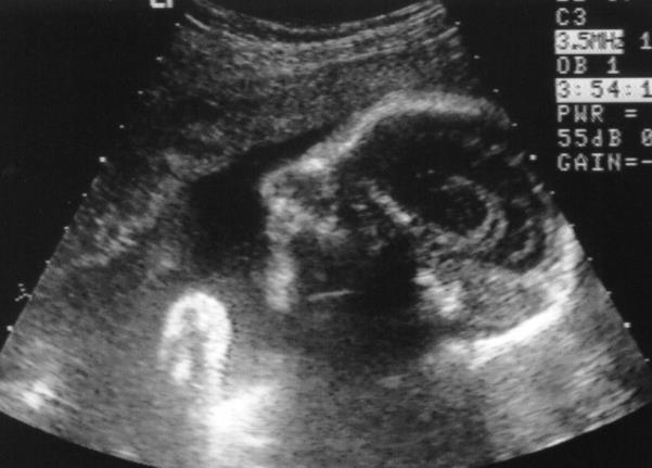 Χαρακτηριστικά του προσώπου στις 22 εβδομάδες εμβρυϊκής ηλικίας: