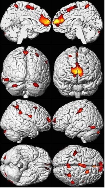 Απεικόνιση εγκεφάλων ενηλίκων που εκτέθηκαν σε μόλυβδο Σμίκρυνση
