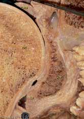 Κεφαλαιο 4 - Κλινική - Λειτουργική Ανατομία ώμου 49 A B Γ Εικόνα 4-7 A: Παρουσιάζεται η ωμογλήνη μετά την απεξάρθρωση της βραχιονίου κεφαλής σε μονιμοποιημένο πτωματικό παρασκεύασμα.