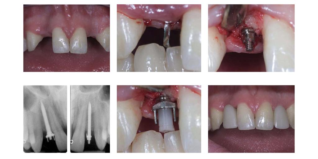 Anew Implant-supported Crowns Completed in a Single