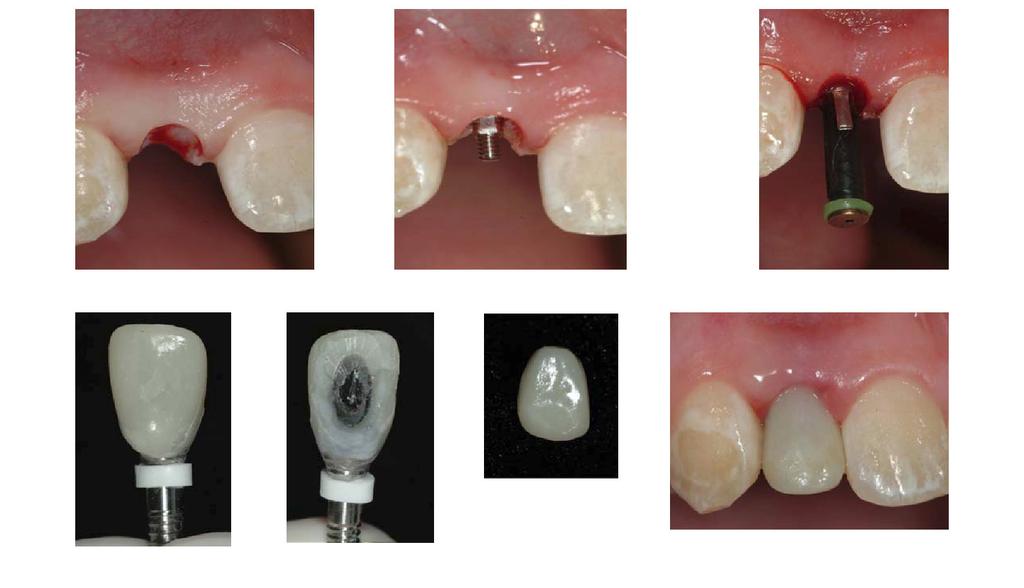 Single tooth replaced with Anew Implant-supported