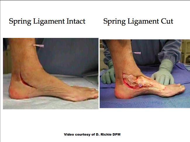 Posterior Tibial dysfunction alone will