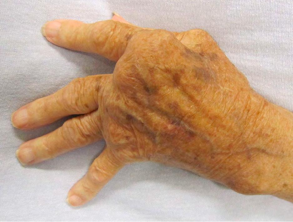 Εικόνα 9.9 Ωλένια απόκλιση δακτύλων σε ρευματοειδή αρθρίτιδα (https://commons.wikimedia.