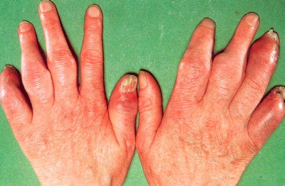 Εικόνα 9.11 Δάκτυλα δίκην λουκάνικου σε ψωριασική αρθρίτιδα (Από http://howshealth.com/dactylitis-symptoms-pictures-causes-treatment/) 3.4.