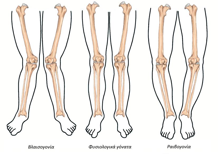 3.6 Άρθρωση γόνατος Η κλινική εξέταση του γόνατος παρουσιάζεται στο Βίντεο 9.4. 3.6.1 Επισκόπηση Ελέγχεται σε ύπτια θέση η παρουσία παραμορφώσεων (βλαισό ραιβό γόνατο, Εικόνα 9.